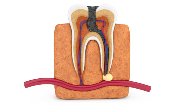kanal tedavisi diş yapısı