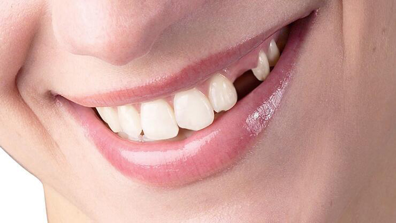 Diş Kaybı Önlemleri ve Tedavileri
