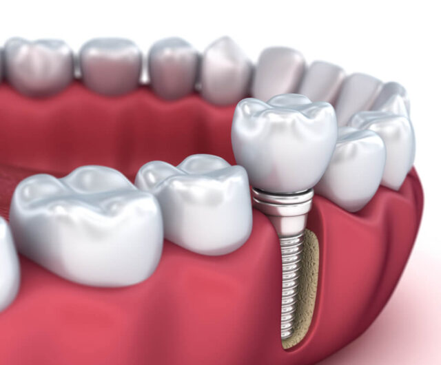 Diş kaybı sonrası implant tedavisi