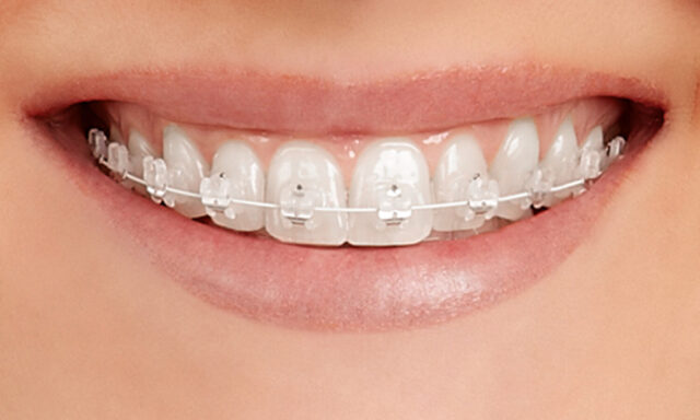 Ortodonti tedavi yöntemleri