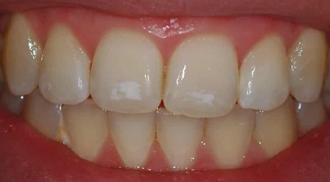 Dişteki Beyaz Lekeler Nasıl Oluşur ?