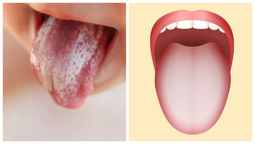Ağız İçi Mantar Enfeksiyonları (Oral Thrush)