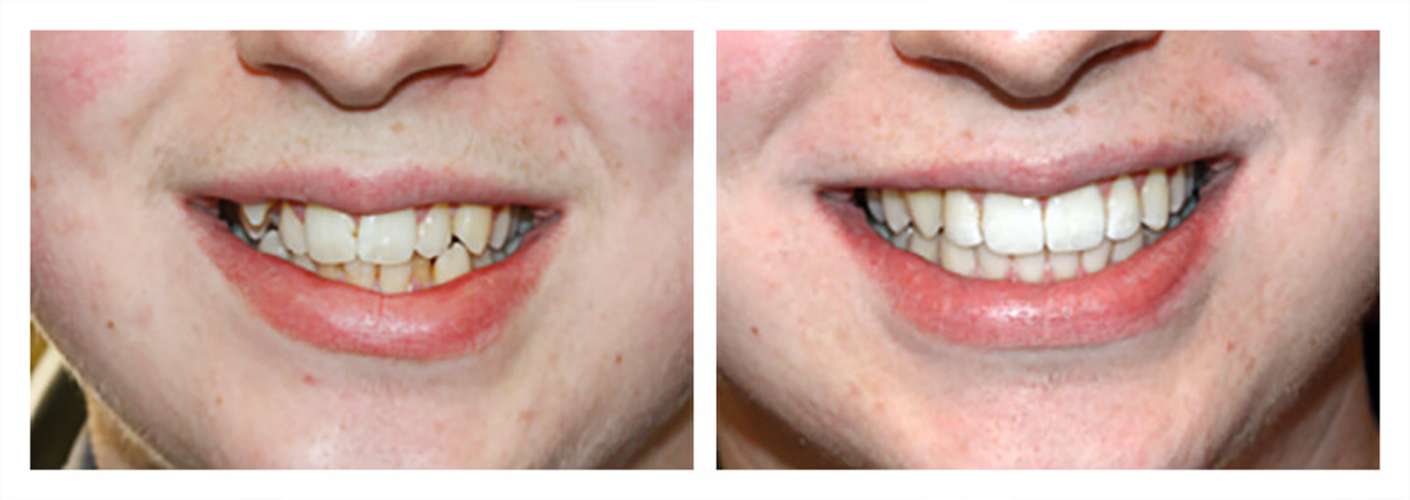 Ortodonti Tedavisi Sonrası Dişler Eski Haline Döner mi? Dentium Ağız