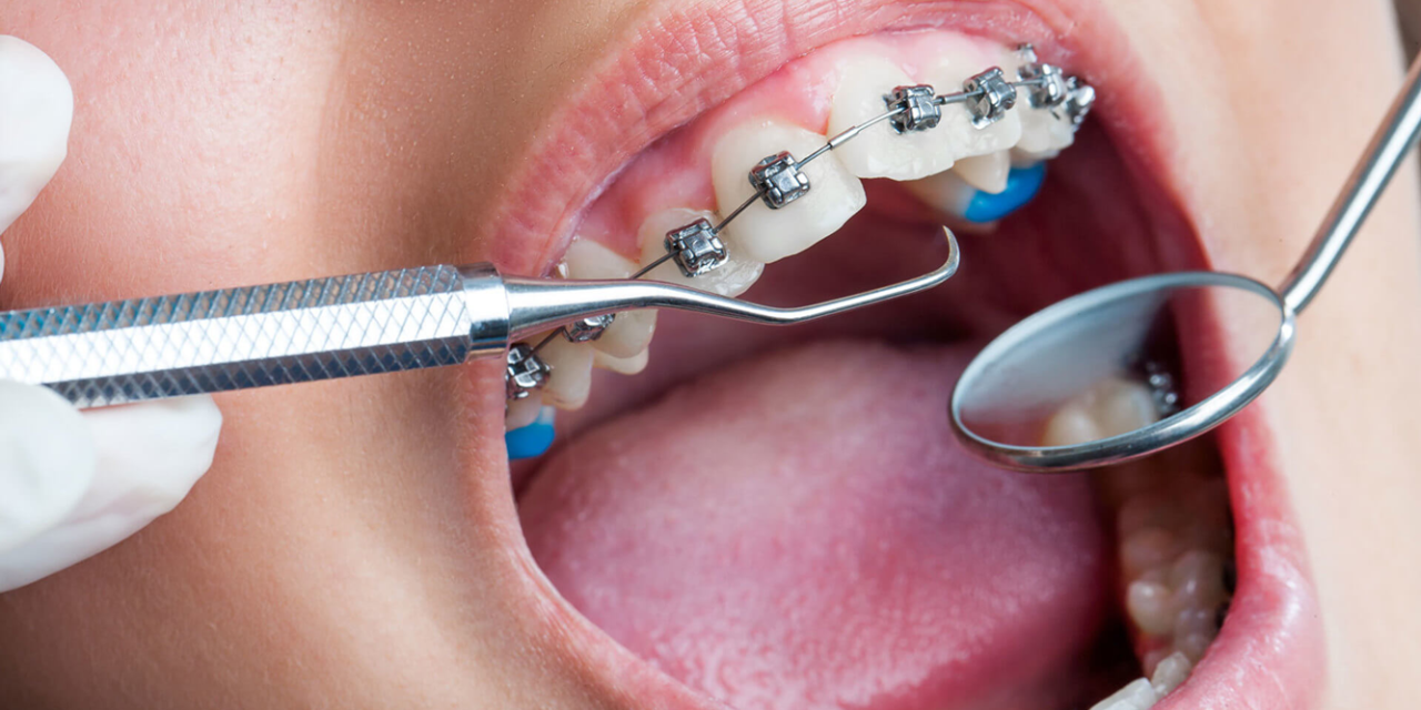 Hangi Durumlarda Ortodonti Tedavisi Kullanılmalıdır ? Konya ortodonti