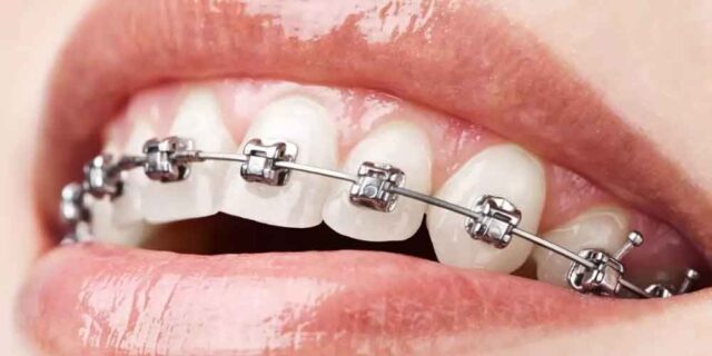 konya ortodonti tedavisi