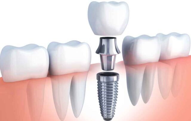 implant fiyatları, konya diş hastanesi ,implant tedavisi