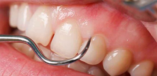 Periodontoloji nedir, periodontoloji tedavisi, diş eti