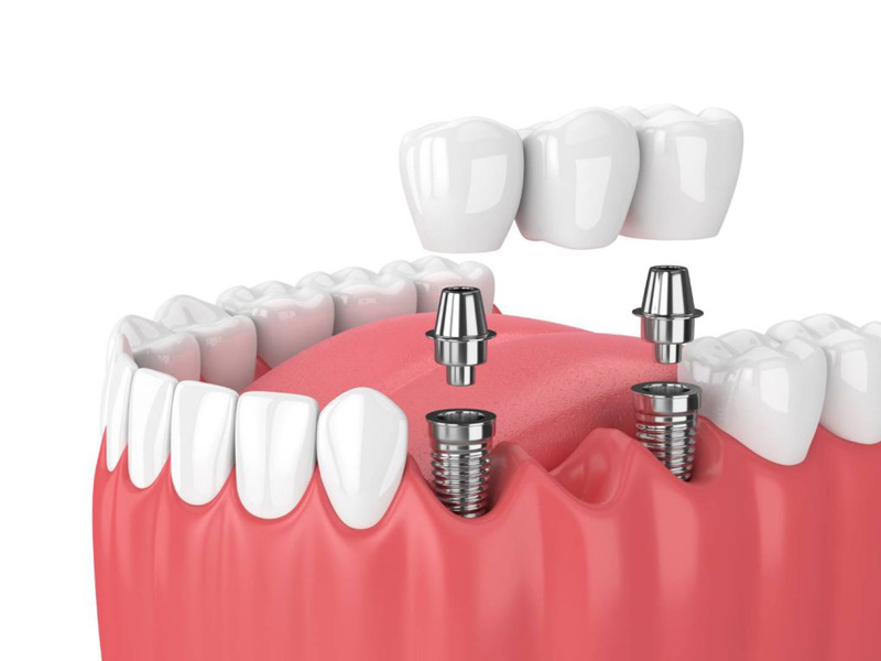 Sabit Protez Hangi Dişlere Yapılır ?