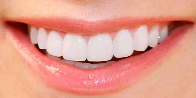 Diş Laminasyonu: Mükemmel Gülüş Estetiği İçin İdeal Bir Çözüm