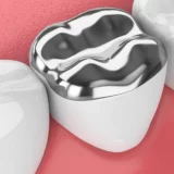 Onlay Dolgu: Diş Restorasyonunda Estetik ve Dayanıklılığın Birleşimi
