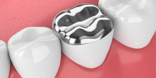 Onlay Dolgu: Diş Restorasyonunda Estetik ve Dayanıklılığın Birleşimi