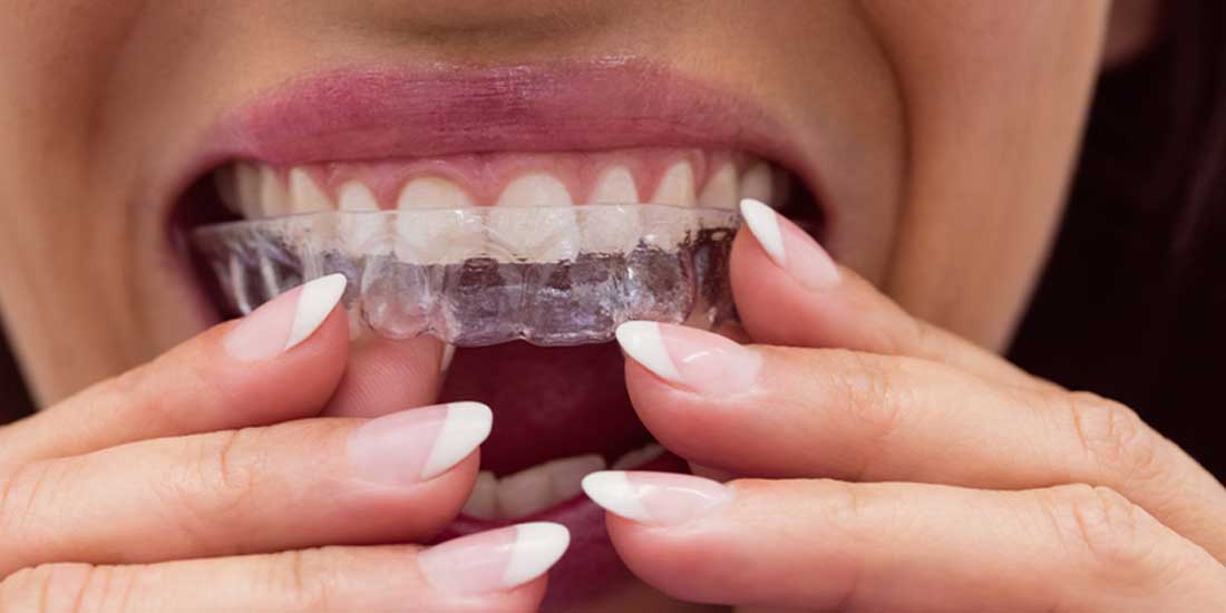 Şeffaf Diş Plağı Tedavi Süreci ve Avantajları